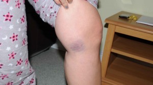 Injuries allegedly sustained by the victim on her knee after she was attacked by suspended Senator Patrick Brazeau in a house they shared.